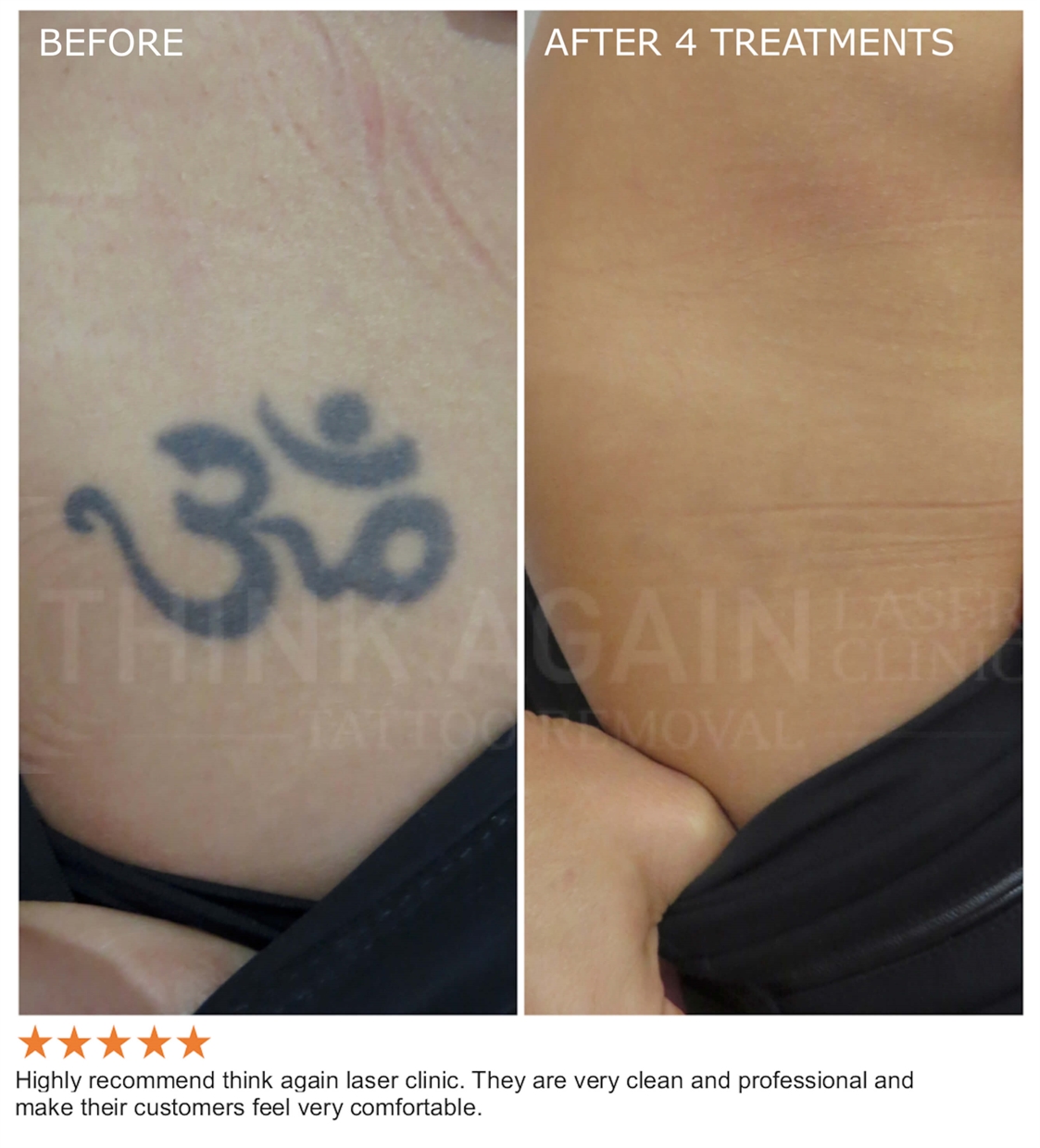 Does Laser Tattoo Removal Really Work ...