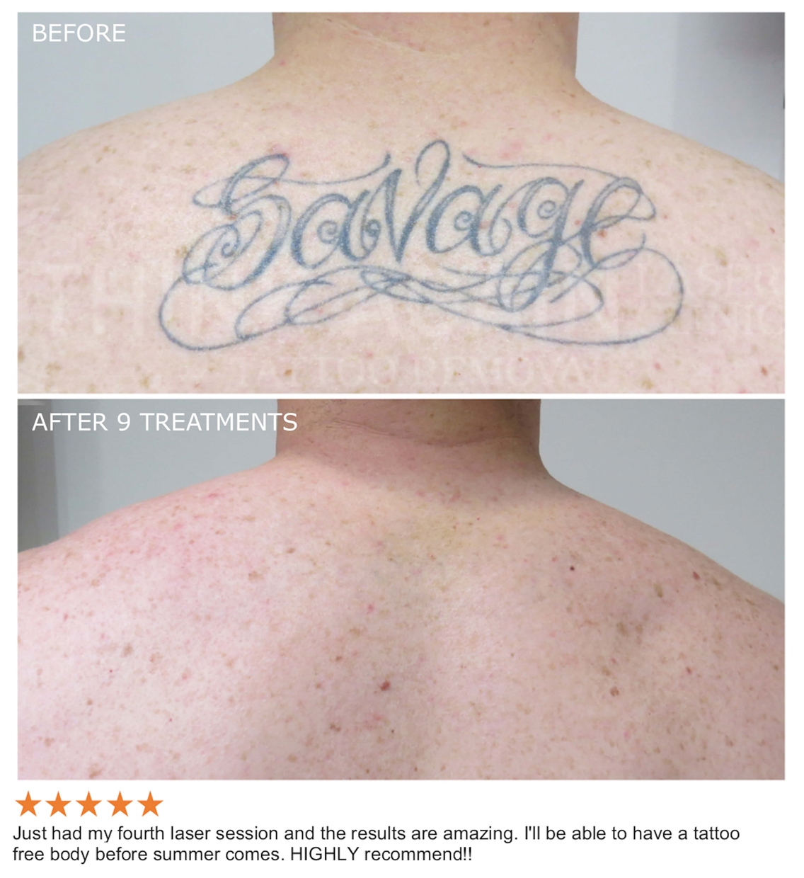 Tattoo Removal in Delhi  Tattoo Removal Cost  Tattoo Removal