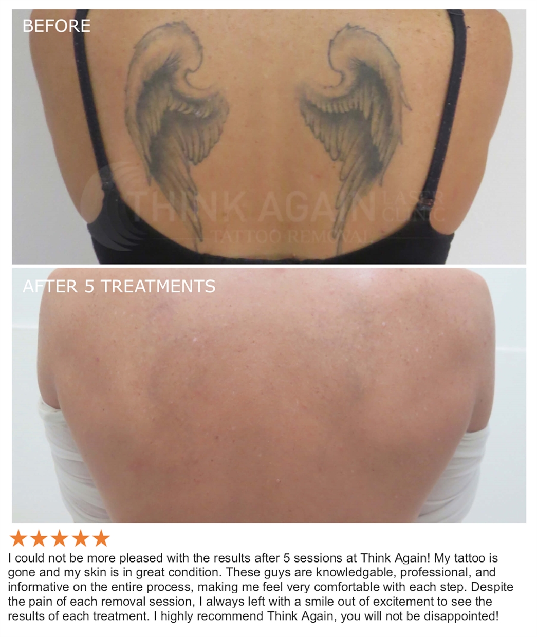 Laser Tattoo Removal Sydney - The #1 Rated Tattoo Removal Clinic