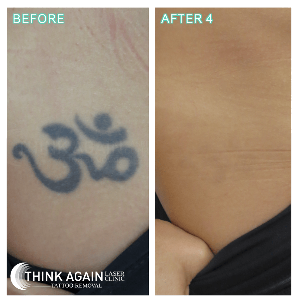 Laser Tattoo Removal | Professional Tattoo Removal