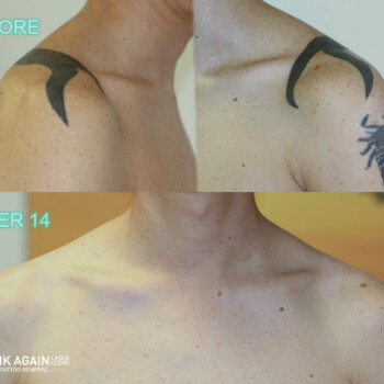 Laser Tattoo Removal in Melbourne - Lady Ink